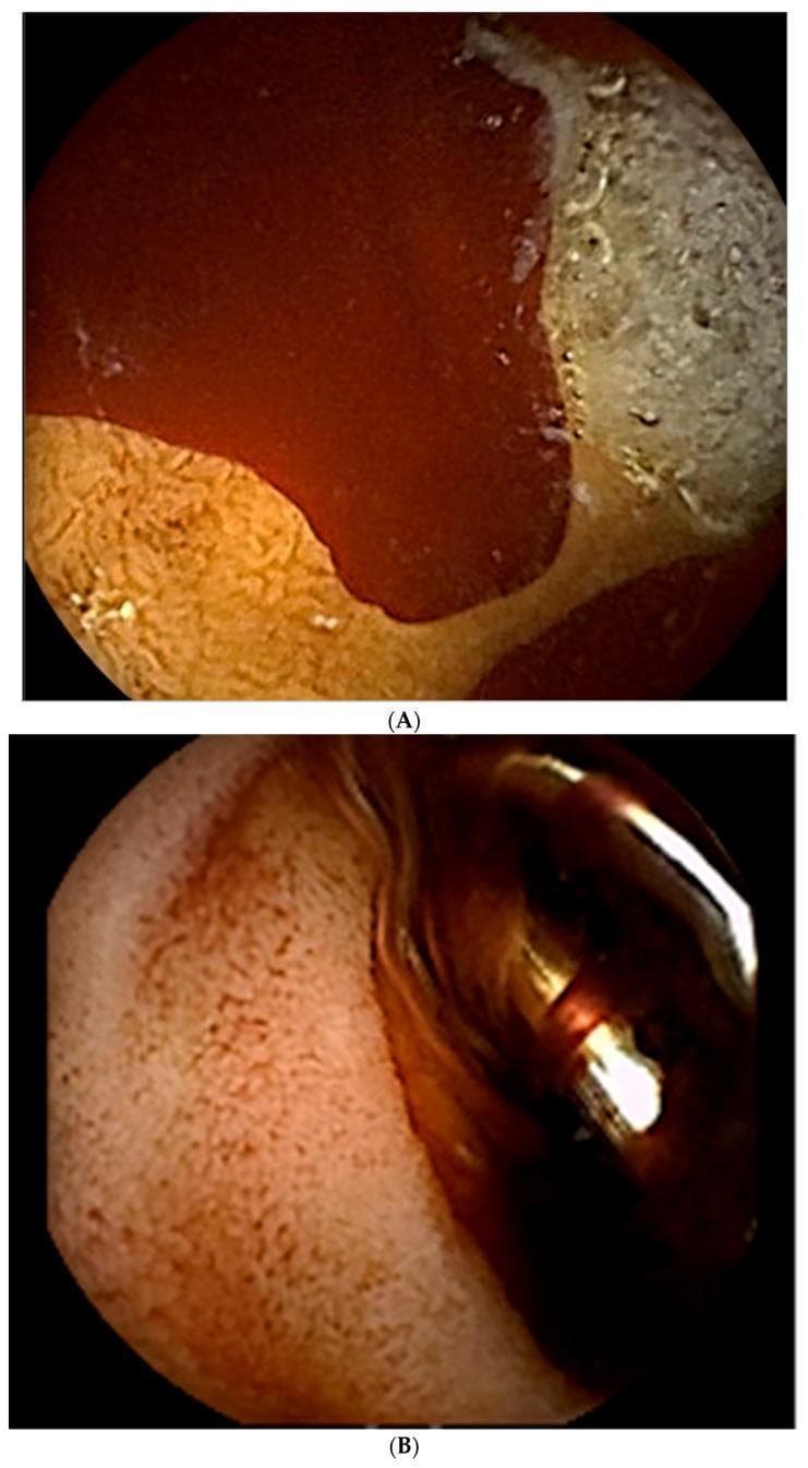 This composite educational image features two frames (A and B) from an upper gastrointestinal endoscopy, illustrating the diagnosis and treatment of acute peptic ulcer bleeding in the duodenal bulb. Frame A demonstrates clinical findings of hematemesis and melena, showing two cratered, oozing ulcers located in the duodenum. Significant active hemorrhage is visible as bright red blood pooling over the mucosal surface. The largest ulcer measures approximately 10 mm in diameter with a visible base. Frame B shows the immediate post-intervention state following the administration of 1:10,000 epinephrine (4cc) and the deployment of metallic hemostatic clips. A hemostatic clip is clearly visible, mechanically compressing the ulcerated site to achieve primary hemostasis. The surrounding mucosa appears altered in color, showing a reddish-orange hue with reduced active bleeding compared to the initial diagnostic view. This sequence serves as a clinical teaching tool for endoscopic management of gastroduodenal artery-related bleeding and the utilization of endoscopic markers to guide subsequent angiographic interventions.