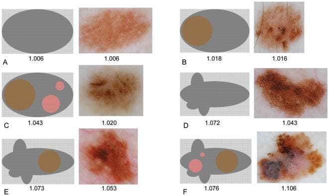 A comparison chart illustrating the classification of pigmented skin lesions through schematic representations and clinical dermoscopic photographs. The figure is organized into six pairs (A-F), demonstrating a progression of morphological irregularity. On the left of each pair, a gray schematic diagram represents the lesion's lacunarity and geometric properties; on the right, a corresponding clinical dermoscopic image shows real-world examples. The progression moves from (A) 'No irregularity'—a smooth oval with homogenous pigmentation—to (B) simple internal asymmetry, (C) hierarchical internal asymmetry with multiple colored internal regions, and (D-F) increasing boundary asymmetry with lobulated borders and complex internal architectural patterns. Key dermoscopic features visible in the clinical images include reticular networks, globules, and varied pigmentation ranging from light tan to dark brown and reddish-purple. The figure serves as a diagnostic educational tool for identifying risk factors in melanocytic lesions, highlighting how mathematical lacunarity values correlate with increasing clinical and structural complexity.