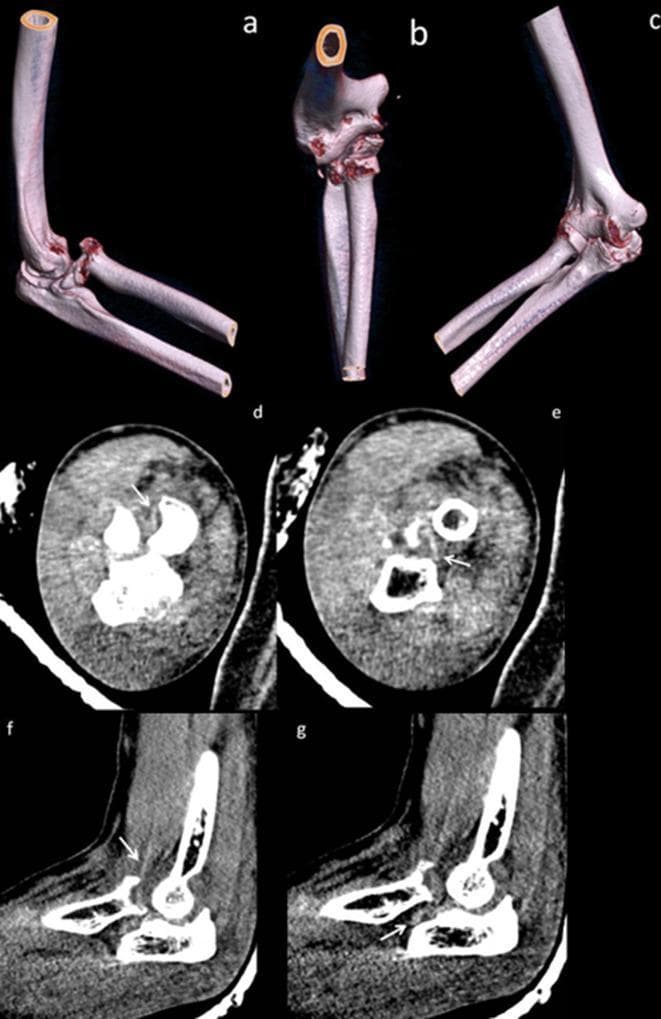 Diagnostic imaging series of the right elbow demonstrating an anteromedial fracture-dislocation of the radial head. Panels (a-c) present volume-rendered 3D CT reconstructions in anterior oblique and anteroposterior views, highlighting a comminuted radial head fracture involving approximately 25% of the articular surface. Small osseous fragments are visible wedged posterior to the radial head and within the radial notch of the ulna. Rotatory subluxation is indicated by the malalignment of the ulnar trochlear notch relative to the humeral trochlea. Panels (d-e) show axial CT slices, and (f-g) show sagittal slices in soft tissue windows. These cross-sectional images identify the brachialis tendon (white arrows) as a linear hyperdensity traversing posterolateral to the radial head fracture site. This anatomical relationship is clinically significant as it illustrates a soft tissue 'sling' effect that can impede manual reduction of the dislocation. The content is suitable for orthopedic and radiology education focusing on complex elbow trauma and the identification of mechanical blocks to reduction.