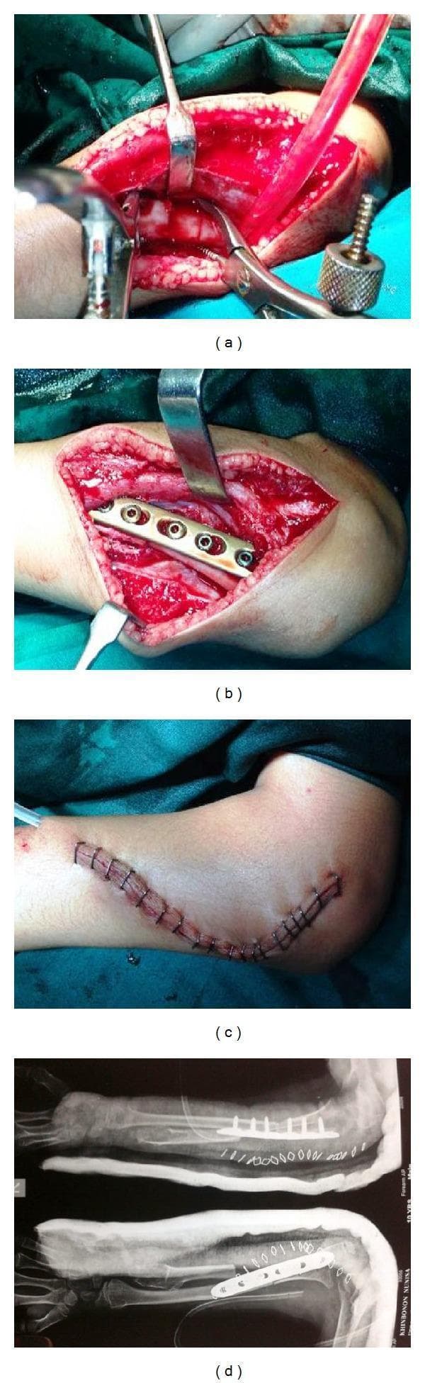 This composite educational graphic illustrates a multi-stage orthopedic surgical procedure for forearm bone reconstruction and fixation. Panel (a) shows an intraoperative clinical photograph of the surgical site with muscle retraction and use of surgical instruments to expose the radius and ulna. Panel (b) demonstrates the internal fixation phase, featuring a metallic locking compression plate secured with five screws onto a bone segment, effectively bridging a surgical osteotomy. Panel (c) shows the post-operative skin closure with a long, curvilinear incision along the dorsal-lateral forearm secured by surgical staples. Panel (d) presents postoperative anteroposterior (AP) and lateral radiographic views of the forearm. These X-rays confirm the alignment of the distal radius with the proximal ulna, showing the metallic plate and screw construct in situ. The radiographs also demonstrate the absence of the proximal radius following excision and the presence of a surgical drain. This sequence is representative of a complex reconstruction for conditions such as radial head dislocation or distal ulnar deficiency.