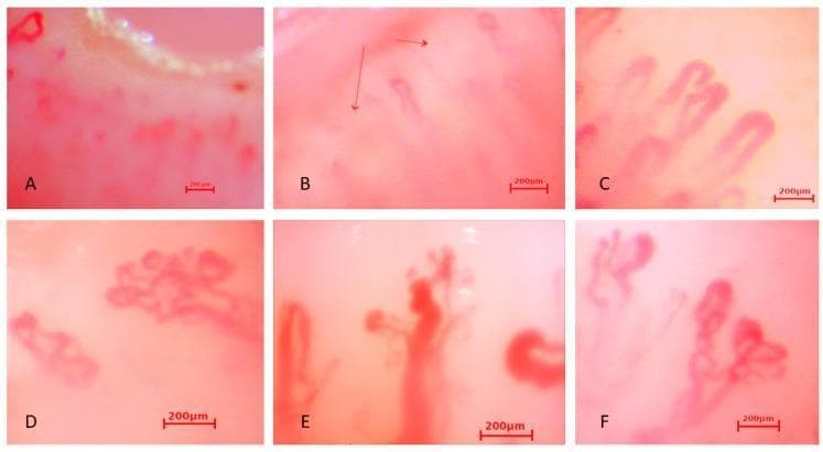 This composite image presents six nailfold capillaroscopy micrographs (labeled A-F) demonstrating various microvascular abnormalities characteristic of systemic sclerosis or secondary Raynaud's phenomenon. (A) and (B) illustrate capillary loss or rarefaction, with a significantly reduced density of vascular loops against a pale background. (C) depicts 'giant capillaries,' characterized by extreme homogeneous dilation and tortuosity of the vascular loops. (D) and (F) showcase 'bizarre capillaries,' exhibiting highly irregular, branched, and bushy morphological distortions that deviate from the standard U-shape. (E) demonstrates active neoangiogenesis, evidenced by clusters of disorganized, newly formed microvessels and exuberant branching patterns. Each frame includes a 200 µm scale bar for size reference. These visual findings are critical diagnostic markers in rheumatology for evaluating microangiopathy and connective tissue diseases.