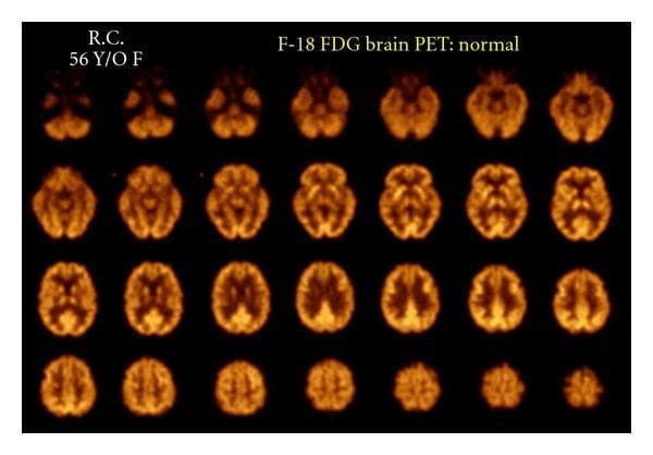 This diagnostic image displays a series of F-18 fluorodeoxyglucose (FDG) Positron Emission Tomography (PET) axial slices of a human brain from a 56-year-old female. The montage represents a normal baseline scan conducted at rest, showcasing 28 sequential cross-sectional slices from the cerebellum and skull base through the vertex. The radiotracer distribution is characterized by symmetrical, physiological uptake throughout the cerebral cortex and subcortical structures. Consistent metabolic activity is observed in the frontal, parietal, temporal, and occipital lobes, as well as the basal ganglia and thalamus. There is a high grey-to-white matter contrast, which is normal for FDG PET imaging. No focal areas of pathological hypometabolism or hypermetabolism are present, indicating preserved glucose metabolism across all neuroanatomical regions. This imaging modality is used in neurology and nuclear medicine to evaluate regional cerebral metabolic rates of glucose (rCMRglu), serving as a reference for diagnosing conditions like epilepsy, neurodegenerative diseases, or focal brain lesions.