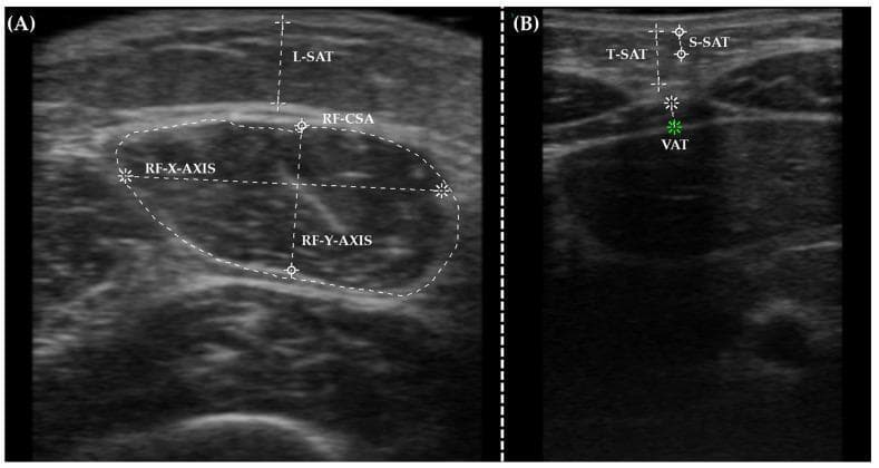 This diagnostic ultrasound image demonstrates 'Nutritional Ultrasound' techniques for assessing body composition through muscular and adipose tissue measurements. Image (A) shows a transverse view of the rectus femoris muscle. Key annotations include the rectus femoris cross-sectional area (RF-CSA) traced with a dotted white line, and its internal dimensions marked by the RF-X-AXIS and RF-Y-AXIS. The overlying leg subcutaneous adipose tissue (L-SAT) is measured with a vertical calliper. Image (B) displays an abdominal ultrasound assessment of adipose compartments. Measurements highlight the total subcutaneous abdominal adipose tissue (T-SAT), the superficial subcutaneous abdominal fat layer (S-SAT), and the deeper visceral adipose tissue (VAT) indicated by a green marker. These imaging modalities are used in clinical nutrition to objectively quantify muscle mass and fat distribution, providing more detailed data than traditional anthropometric measurements for monitoring metabolic health and nutritional status in hospital settings.