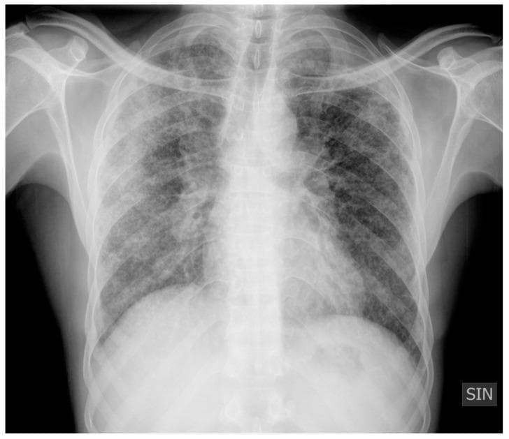 Anteroposterior (AP) chest X-ray demonstrating characteristic findings of pulmonary sarcoidosis, categorized as Scadding Stage II. The image reveals bilateral, symmetric hilar lymphadenopathy, characterized by prominent, well-defined densities at the lung roots. The lung parenchyma shows diffuse abnormalities, including multiple micronodules with a peribronchovascular distribution and extensive reticulonodular opacities scattered throughout both lung fields. Additionally, there is a localized area of pulmonary consolidation visible in the right lung. These findings represent a combination of thoracic adenopathy and active parenchymal infiltrates. The overall radiographic pattern is typical of a granulomatous lung disease, illustrating the transition from isolated nodal involvement to interstitial lung disease. This diagnostic image is intended for educational use in pulmonology and radiology to identify nodal and parenchymal patterns in sarcoidosis.