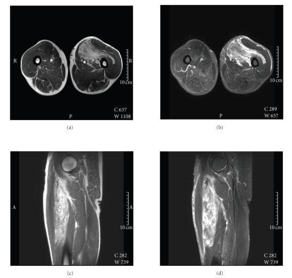 A multi-panel MRI series of the left thigh demonstrating a large, lipomatous soft tissue mass. The collection includes (a) axial T1-weighted, (b) axial fat-saturated STIR, (c) coronal T1-weighted, and (d) coronal T2-weighted images. The mass measures approximately 19 x 8 x 4 cm and is located within the soft tissues of the left thigh. On T1-weighted images, the lesion displays high signal intensity, though slightly lower than the surrounding subcutaneous fat. In the STIR and T2-weighted images, the mass maintains high signal intensity with internal foci of hyperintensity, suggesting a heterogeneous internal structure. The lesion is characterized by a lobulated morphology and irregular, poorly defined boundaries that show intramuscular and subfascial extensions. The lack of a clear capsule and the infiltrative margins are key diagnostic features for assessing soft tissue lipomatous tumors such as pleomorphic lipoma or atypical lipomatous tumor/well-differentiated liposarcoma.