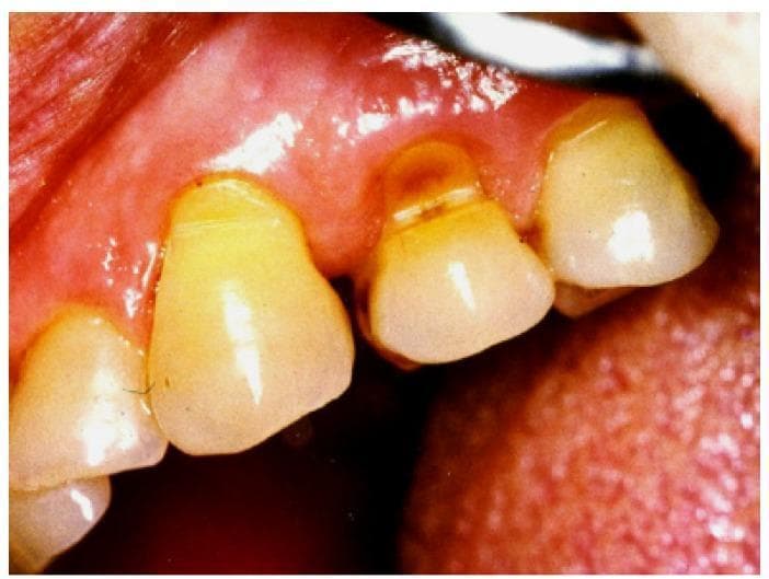 This clinical photograph is an intraoral image showing a classic example of dental abfraction on a premolar. The image highlights a non-carious cervical lesion (NCCL) characterized by a deep, wedge-shaped or V-shaped notch located at the cemento-enamel junction (CEJ). The defect exhibits a sharp internal angle and brownish discoloration within the groove, suggesting exposed dentin. The surrounding gingival tissue shows signs of recession and mild inflammation. This pathology is clinically significant in dentistry as it illustrates the loss of tooth substance due to mechanical loading and tooth flexure during occlusal stress, distinct from other forms of tooth wear such as attrition, erosion, or abrasion. The educational focus is on identifying biomechanically-induced hard tissue loss and distinguishing it from chemical or friction-related dental wear.