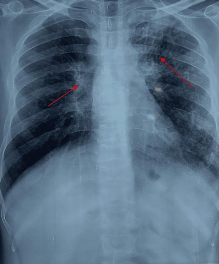 This diagnostic image is a postero-anterior (PA) chest X-ray demonstrating advanced interstitial lung disease. The bilateral lung fields show diffuse, small, rounded nodular opacities, with a clear predilection for the upper and middle zones. Large, irregular areas of consolidation are visible in both upper lobes, consistent with progressive massive fibrosis (PMF), accompanied by volume loss and architectural distortion. The hilar regions appear symmetrically enlarged, suggestive of hilar lymphadenopathy. Linear fibrotic opacities are scattered throughout the parenchyma, and subtle apical pleural thickening is noted. Red arrows highlight specific areas of coalescing nodularity in the mid-to-upper zones. While the cardiac silhouette and mediastinal borders are within normal limits, they are partially obscured by the extensive pulmonary infiltrates. This radiographic pattern is highly characteristic of complicated silicosis or pneumoconiosis, often necessitating clinical correlation for superimposed infections like tuberculosis.