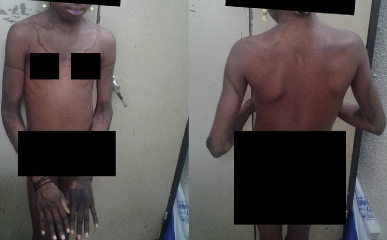 Clinical photograph of a pediatric patient presenting with classical dermatological manifestations of pellagra (niacin deficiency). The image shows well-demarcated, symmetrical, hyperpigmented, and hyperkeratotic plaques. A prominent feature is the 'Casal necklace,' a circumferential band of darkened, thickened skin extending around the neck and onto the upper thorax and back. Additional acral involvement is visible, characterized by symmetrical hyperpigmentation on the dorsal aspects of the hands, wrists, and forearms. The skin in affected areas appears dry and scaly with erythematous margins, consistent with photosensitive dermatitis. The patient exhibits a wasted body habitus, suggesting underlying malnutrition or cachexia. This presentation illustrates the 'Dermatitis' component of the pellagra triad (Dermatitis, Diarrhea, Dementia) and is key for clinical diagnosis in resource-limited settings where dietary niacin or tryptophan intake is insufficient.