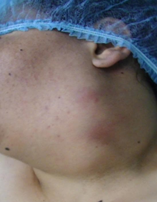 Clinical photograph of a patient's left lateral neck demonstrating a large, voluminous swelling consistent with a branchial cleft cyst (tonsillar cyst). The mass is located in the anterolateral cervical region, extending vertically from the inferior aspect of the ear/mastoid process down toward the supraclavicular area. Visually, the swelling is rounded and significant enough to cause visible asymmetry and contour deformity of the neck. The overlying skin appears slightly erythematous and mildly inflamed, with visible superficial vascularity and areas of uneven pigmentation. The patient is shown wearing a blue surgical cap, indicating a perioperative or clinical setting. This image illustrates the typical clinical presentation of a congenital neck cyst in an adult, highlighting the anatomical distribution and the localized inflammatory response that can occur with such masses.