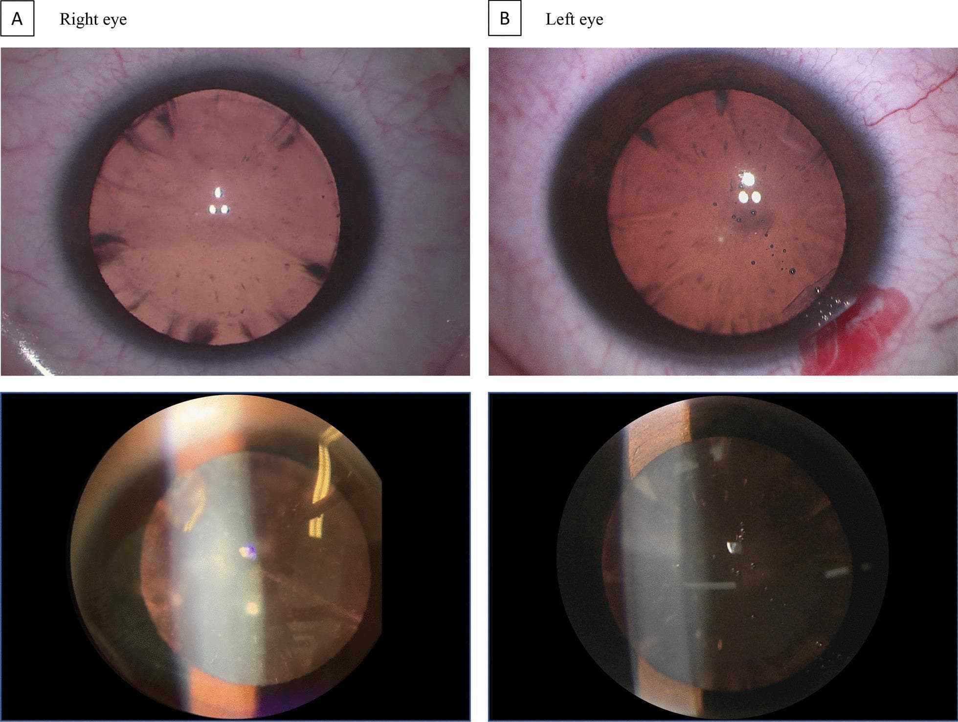 A clinical photograph and slit-lamp examination series depicting bilateral cataracts in a patient with Cerebrotendinous Xanthomatosis (CTX). The top panels (A and B) show retroillumination images of the right and left eyes, respectively, revealing characteristic diffuse, 'fleck-like' cortical opacities. These small, discrete opacities are primarily concentrated in the posterior aspect of the lens. The left eye (Panel B) additionally demonstrates a small area of subconjunctival hemorrhage or localized blood at the limbus. The bottom panels provide slit-lamp biomicroscopy views, confirming the posterior location and morphology of the lens opacities. In the right eye, the opacity appears more centrally defined, while the left eye shows a more scattered distribution. This specific 'fleck-like' posterior cataract morphology serves as a key clinical biomarker for CTX, an inborn error of metabolism. The images illustrate the decrease in lens transparency associated with juvenile-onset bilateral cataracts in metabolic disease.