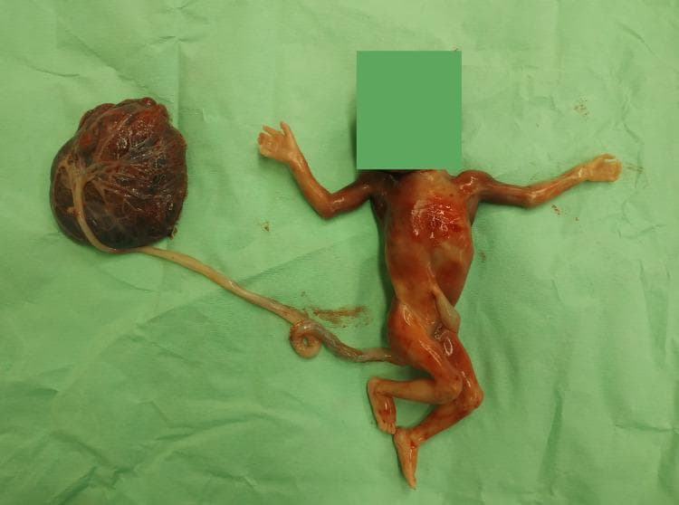 This clinical photograph displays a gross pathological specimen of an intact fetoplacental unit following a first-trimester pregnancy loss or termination at approximately 13-14 weeks of gestation. The specimen is laid out on a green surgical drape. The placenta is a discoid, dark red-to-brown vascular mass with a visible chorionic plate and branching vessels. The umbilical cord is long, pale, and yellowish-white, showing characteristic twisting (coiling) and a marginal or eccentric insertion into the placental disc. The fetus is positioned with limbs extended; the facial area is obscured by a green privacy block. A key diagnostic feature is visible on the fetal left hand, which demonstrates syndactyly (webbing or fusion of digits), serving as a significant morphological marker for fetal anomaly screening. The skin of the fetus appears translucent, consistent with late first-trimester development. This image is relevant for medical students and clinicians studying fetal pathology, embryology, and first-trimester congenital malformations.