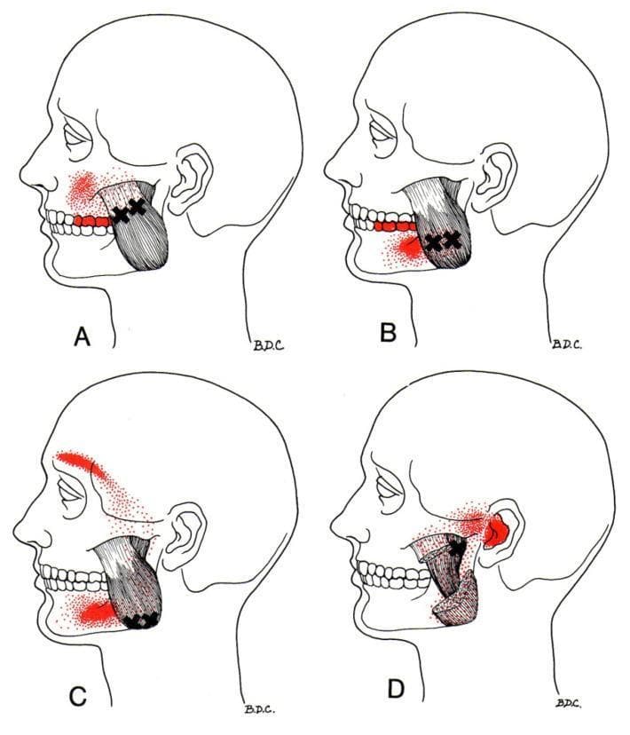 A series of four anatomical diagrams (A-D) illustrating myofascial trigger points in the masseter muscle and their associated referred pain patterns in the human head and neck. Each lateral-view diagram shows the masseter muscle connecting the zygomatic arch to the mandible. Black crosses (X) indicate the primary trigger point locations, while red stippled areas denote the distribution of referred pain. Diagram A shows trigger points in the upper muscle belly referring pain to the maxilla and upper teeth. Diagram B displays trigger points in the lower muscle fibers referring pain to the mandible and lower teeth. Diagram C illustrates trigger points at the inferior mandibular attachment referring pain to the eyebrow, temple, and lower jaw. Diagram D depicts trigger points in the deep layer of the masseter referring pain to the ear and temporomandibular joint (TMJ) region. This educational visual is used to demonstrate the diagnostic clinical findings for temporomandibular disorders (TMD) and craniofacial pain syndromes.