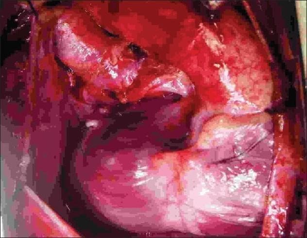 This clinical photograph displays an intraoperative view of a completed pediatric cardiac surgical procedure via a midline sternotomy. The image primarily demonstrates a Bidirectional Glenn (BDG) shunt, characterized by an end-to-side anastomosis between the superior vena cava (SVC) and the superior aspect of the right pulmonary artery (RPA). Visible in the surgical field are the smooth, moist textures of vascular tissues with clear suture lines indicating the anastomotic site. The SVC has been transected from its cardiac end and repositioned to provide direct venous drainage into the pulmonary circulation. Additionally, the field reflects the state following the division of a previously placed right Blalock-Taussig (BT) shunt. The surgical area is well-visualized with anatomical landmarks including the SVC-RPA junction and the surrounding pericardial space. This visual serves as an educational reference for staged palliative surgery in patients with single ventricle physiology or complex congenital heart disease, illustrating the transition from systemic-to-pulmonary shunting to a superior cavopulmonary connection.