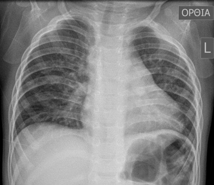 This diagnostic image is an anteroposterior (AP) chest X-ray of a pediatric patient, specifically a 16-month-old male. The image demonstrates a classic 'boot-shaped' heart (coeur en sabot), a hallmark radiographic sign of Tetralogy of Fallot. The cardiac silhouette shows an upturned apex due to right ventricular hypertrophy and a concave main pulmonary artery segment. The lung fields exhibit increased, patchy opacities and markings, particularly prominent in the right lung, which may suggest compensatory pulmonary blood flow or associated bronchial anomalies. The mediastinum appears slightly shifted, and the overall lung volume is clear enough to evaluate the bronchovascular markings. This radiograph serves as a primary educational example of congenital heart disease (CHD) manifestations in pediatric radiology, illustrating the morphological changes to the heart and the secondary effects on pulmonary vascular distribution.