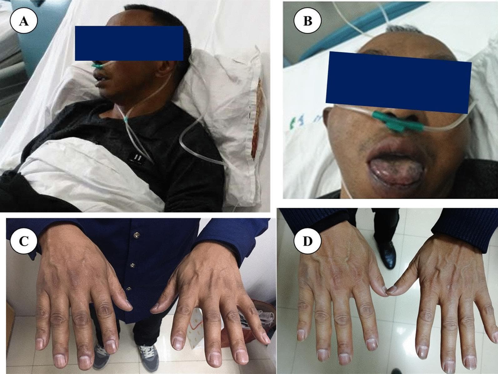 A series of clinical photographs documenting mucocutaneous hyperpigmentation in a patient with Addison’s disease and its partial resolution after treatment. Panel A displays diffuse, dark-brown hyperpigmentation of the facial skin. Panel B focuses on the oral cavity, revealing characteristic dark-brown macules and patches of varying sizes on the tongue and lips. Panel C shows the dorsal aspect of both hands, demonstrating diffuse, dark-brown pigmentation particularly prominent over the knuckles and small joints. Panel D presents the dorsal aspect of the hands after two months of hormone replacement therapy, showing a notable reduction in pigment intensity and a more even skin tone, though mild residual hyperpigmentation persists. These findings illustrate the clinical hallmark of primary adrenal insufficiency (Addison’s disease), where elevated ACTH levels lead to increased melanocyte stimulation, and provide a visual baseline for assessing treatment response.