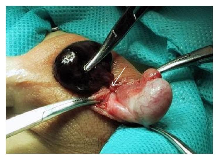 This clinical intraoperative photograph shows a surgical exploration of the left scrotum in a pediatric patient. The image features a large, dark, globular mass identified as an encysted hydrocele of the cord. The deep purple-to-black coloration of the hydrocele sac indicates hemorrhagic contents (bloody fluid), likely due to the torsion of the hydrocele. A white arrow points to the site of a 360-degree rotation (torsion) at the distal end of the sac. Adjacent to the hydrocele, the testis and epididymis are visible, appearing as pinkish-white, smaller, and morphologically normal structures with preserved vascularization, distinct from the pathology of the hydrocele. Several surgical hemostats are seen retracting the scrotal tissues to provide exposure. The image demonstrates a rare case of acute scrotum caused by the torsion of a non-communicating hydrocele, a critical differential diagnosis for testicular torsion.