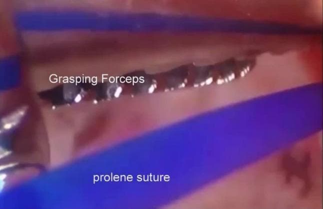 An intra-operative arthroscopic photograph from a temporomandibular joint (TMJ) surgery demonstrating the placement of a repositioning suture. The field of view shows the superior joint space, characterized by smooth, pinkish synovial and connective tissue. Central to the image, a pair of metallic alligator grasping forceps with distinctive jagged, interlocking teeth is visible. The forceps are positioned to capture and manipulate a blue monofilament Prolene suture, which appears as a bright blue, linear structure diagonally across the field. This procedural step illustrates the technique of endaural repositioning or plication, where the suture is passed through the articular disc or bilaminar zone to stabilize the joint anatomy. The image highlights the use of triangulation in arthroscopy, involving specialized instrumentation to manage sutures within a restricted anatomical compartment.