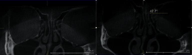 This diagnostic image consists of two side-by-side coronal Cone Beam Computed Tomography (CBCT) scans of the paranasal sinuses and anterior skull base. The primary focus is the radiological evaluation of the ethmoid roof anatomy. Key anatomical structures visible include the cribriform plate (CP), lateral lamella (LL) of the cribriform plate, ethmoid roof (ER), orbits, and maxillary sinuses. On the right-hand panel, a quantitative angular measurement of 42.7 degrees is displayed on the patient's left side. This measurement represents the angle between the lateral lamella and the horizontal plane of the cribriform plate, which is a critical landmark in the Gera classification system. An angle of 42.7 degrees corresponds to a Gera Type III classification, indicating an acute slope and high anatomical risk for iatrogenic skull base injury during functional endoscopic sinus surgery (FESS). The images illustrate the topographical relationship between the olfactory fossa depth and the surrounding orbital floor (OFL) landmarks used for preoperative surgical planning and risk stratification.