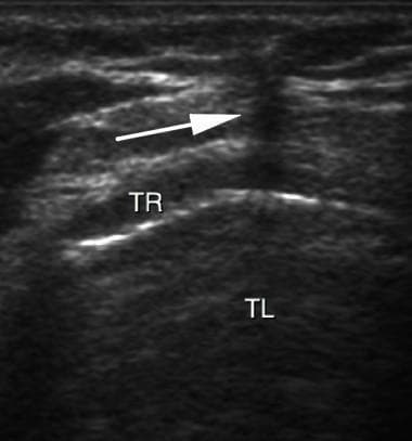 This diagnostic ultrasound image demonstrates a transversal (cross-sectional) view of the neck during a percutaneous tracheostomy procedure. The primary anatomical structures shown include the tracheal lumen (TL), visible as an anechoic (dark) central area, and the tracheal rings (TR), which appear as hyperechoic (bright), curved, discontinuous lines anterior to the lumen. A white arrow points to a vertical, hypoechoic acoustic shadow created by the out-of-plane approach of a puncture needle. This shadow serves as a visual marker for needle localization as it advances toward the anterior tracheal wall. The image illustrates the clinical application of real-time ultrasound guidance to ensure safe needle placement during airway management. Key educational concepts include ultrasound anatomy of the trachea, recognition of acoustic artifacts (shadowing), and procedural guidance techniques for intensive care or surgical settings.