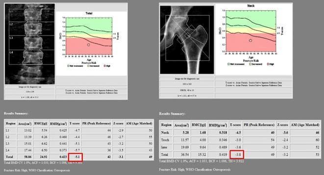 Dual-energy X-ray absorptiometry (DEXA) scan report presenting bone mineral density (BMD) analysis of the lumbar spine and proximal femur. The image is divided into two clinical diagnostic panels. The left panel shows the lumbar spine (L1–L4) with segmented vertebral regions, an associated fracture risk graph plotting BMD against age, and a quantitative 'Results Summary' table. The highlighted total T-score of -5.1 for the lumbar spine is significantly below the -2.5 threshold, indicating severe osteoporosis. The right panel displays the proximal femur (hip) with demarcated regions for the femoral neck, trochanter, and intertrochanteric area. Its corresponding fracture risk graph shows a data point deep within the red 'High Risk' zone. The summary table for the femur highlights a total T-score of -3.8, confirming a diagnosis of osteoporosis. Both panels include Z-scores, peak reference percentages (PR), and age-matched percentages (AM). This comparison chart illustrates diagnostic imaging and metabolic bone disease assessment for clinical education on osteoporosis classification and fracture risk stratification.