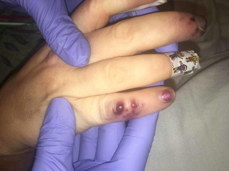 This clinical photograph displays characteristic peripheral stigmata of infective endocarditis on a patient's hand. The primary findings are Osler's nodes, seen as painful, raised, violaceous nodular lesions located on the distal aspect of the fourth digit. These nodules exhibit a deep red-to-purple hue and appear slightly edematous, indicative of immune complex-mediated vasculitis. Additionally, the index finger displays splinter hemorrhages, visible as small, linear, dark reddish-brown streaks beneath the nail bed, representing micro-emboli or capillary damage. The middle finger is partially occluded by a patterned medical adhesive bandage. A healthcare provider in purple nitrile gloves is holding the hand, facilitating the clinical examination. These visual signs are critical diagnostic indicators for bacterial endocarditis, often associated with systemic bacteremia and valvular vegetations. The image serves as an educational tool for identifying classic dermatological manifestations of systemic cardiovascular infection.