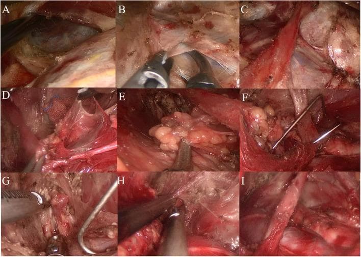 This composite of nine clinical endoscopic frames (A-I) documents a lateral neck selective lymph node dissection (levels IIa–IV) via a transaxillary non-inflatable approach. (A) Shows the posterior border of the sternocleidomastoid muscle. (B) Illustrates the exposure of the internal jugular vein (IJV) after freeing the cervical fascia. (C) Demonstrates the isolation and preservation of the omohyoid muscle. (D, E) Depict the systematic dissection and removal of lymph node clusters within Level IV and Level III, respectively, using laparoscopic graspers. (F) Shows the insertion of a specialized metallic pull hook to retract the IJV, improving visualization of deeper structures. (G, H) Show the dissection of Level IIa nodes and the subsequent exposure of the digastric muscle, which serves as the superior surgical boundary. (I) Displays the final surgical field following the completed lymphadenectomy, showing the preserved major neurovascular structures and musculature in a 'skeletalized' state. The series illustrates key surgical landmarks including the sternocleidomastoid, omohyoid, and digastric muscles, and the internal jugular vein.