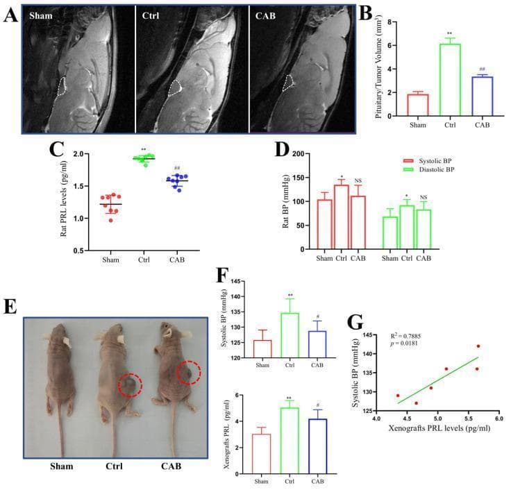 Educational figure illustrating blood pressure (BP) and hormone changes in rodent prolactinoma models across three experimental groups: Sham (control), Ctrl (untreated prolactinoma), and CAB (cabergoline-treated). Panel A presents sagittal T2-weighted MRI images of a rat in situ prolactinoma model, with white dashed lines delineating the pituitary/tumor region, showing significant enlargement in the Ctrl group compared to Sham, and reduction following CAB treatment. Panel B quantifies tumor volume (mm³), while Panel C shows corresponding serum prolactin (PRL) levels (pg/ml). Panel D provides a bar graph of systolic and diastolic blood pressure in rats. Panel E displays clinical photographs of a mouse xenograft model with tumors highlighted in red circles; the Ctrl group shows a prominent subcutaneous mass that appears reduced in the CAB group. Panels F and G correlate these findings with mouse systolic BP, serum PRL levels, and a regression analysis (R²=0.7885) showing a positive correlation between PRL and systolic BP. This figure demonstrates the efficacy of dopamine agonists in reducing tumor volume and hyperprolactinemia-associated hypertension.