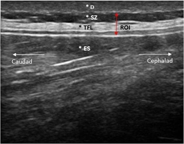 This diagnostic image is a high-frequency (18 MHz) ultrasound in a longitudinal/parasagittal plane of the lumbar region (L2-L3 level), illustrating the musculoskeletal anatomy of the posterior trunk. The sonogram demonstrates four distinct anatomical layers from superficial to deep: the dermis (D), which appears as a thin, relatively hypoechoic superficial boundary; the subcutaneous zone (SZ), a slightly more echogenic fatty layer; the thoracolumbar fascia (TFL), visualized as a prominent, highly echogenic (hyperechoic) linear band; and the erector spinae (ES) muscle, appearing as a thick, heterogeneous layer with characteristic linear, hyperechoic striations. A vertical double-headed red arrow defines a Region of Interest (ROI) spanning from the subcutaneous zone through the thoracolumbar fascia. Orientation markers indicate the caudal direction to the left and cephalad direction to the right. The image serves as an educational reference for identifying fascial planes and paraspinal muscle architecture, specifically for evaluating the organization and morphology of the perimuscular connective tissue.