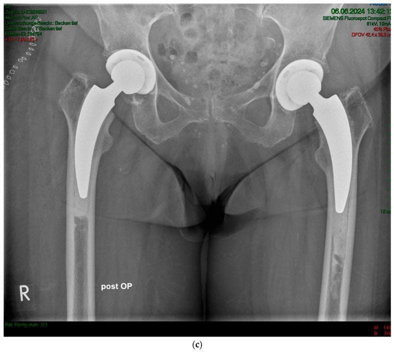This diagnostic image is an anteroposterior (AP) pelvic X-ray demonstrating bilateral total hip arthroplasty in an 85-year-old female patient with osteoarthritis. The image shows sequential implantation of cemented A2 femoral stems. Both the left and right femurs exhibit radiopaque stainless-steel implants consisting of a femoral head articulating with an acetabular component and a calcar-guided stem extending into the femoral canal. A visible cement mantle surrounds both stems, appearing as a moderately radiopaque layer between the dense metal implant and the cortical bone. On the right side (labeled 'R'), the cement stopper is positioned immediately distal to the stem tip. On the left side, there is evidence of slight distalization of the cement stopper. The pelvic bone quality shows signs of reduced density consistent with age-related changes (Dorr Type B-C femora) and heterogeneity suggesting bone remodeling. This image illustrates postoperative orthopedic positioning and the use of cemented backups in patients with poor bone quality.