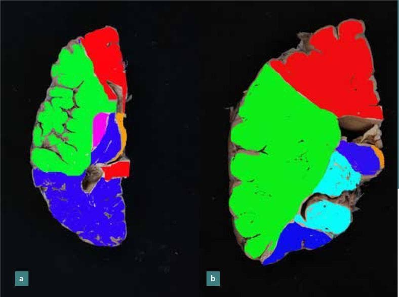 This medical anatomical diagram illustrates the arterial blood supply territories of the human brain through color-coded mapping on axial and coronal sections. Image 'a' displays an axial section at the level of the genu of the corpus callosum, while image 'b' shows a coronal section at the level of the head of the caudate nucleus. The primary vascular territories are identified as follows: red represents the Anterior Cerebral Artery (ACA), supplying the superior and medial aspects; green denotes the Middle Cerebral Artery (MCA), covering the extensive lateral and central regions; and blue indicates the Posterior Cerebral Artery (PCA) territory at the base and posterior aspects. Additionally, smaller vascular zones are identified, including the anterior choroidal artery (purple in 'a', light blue in 'b') and the posterior communicating artery (orange). Blue arrows highlight the border zones or watershed regions between major territories, which are clinically significant as areas highly susceptible to ischemia during hypoperfusion. This visual resource is designed for medical students and clinicians to understand neurovascular anatomy and the pathophysiology of watershed strokes.
