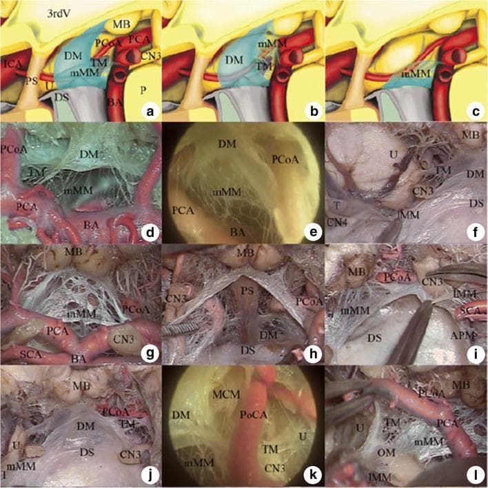 Educational composite image consisting of schematic drawings, anatomical dissections, and endoscopic views illustrating the complex microanatomy of Liliequist's membrane. Panels (a-c) present Zhang's classification: Type I (oblique Y-shaped/inverted L-shaped) and Type II configurations. Panels (d-i) demonstrate surgical anatomy of Type I membranes, highlighting the diencephalic (DM) and medial mesencephalic (mMM) leaflets. Key neurovascular relationships are visible, including the proximity of the membrane to the basilar artery (BA), oculomotor nerve (CN3), mamillary bodies (MB), and the posterior cerebral (PCA) and posterior communicating (PCoA) arteries. High-resolution dissections (j-l) specifically detail the temporal membrane (TM) and its origin from the lateral border of the diencephalic leaflet. The images emphasize the membrane’s role as an arachnoid barrier between the interpeduncular and prepontine cisterns, providing critical anatomical landmarks for neurosurgical procedures such as third ventriculostomy and skull base approaches.