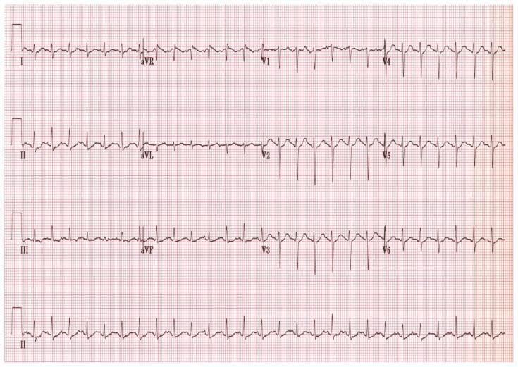 This diagnostic image is a standard 12-lead electrocardiogram (ECG) recorded on a pink grid background. The tracing displays the limb leads (I, II, III), augmented limb leads (aVR, aVL, aVF), and precordial leads (V1-V6) arranged in a traditional four-column format, with a continuous rhythm strip of lead II at the bottom. The horizontal axis represents time at a standard speed (25 mm/sec) and the vertical axis represents voltage (10 mm/mV). The ECG shows a regular sinus rhythm with narrow QRS complexes and distinct P and T waves. Notable morphology includes a normal R-wave progression in the precordial leads, characterized by increasing R-wave amplitude from V1 through V6. In lead V1, the QRS complex is primarily negative (rS pattern), transitioning to a primarily positive deflection by V5-V6. This visual material is used in clinical cardiology education to teach baseline cardiac rhythm analysis, waveform recognition, and lead-specific morphological variations.