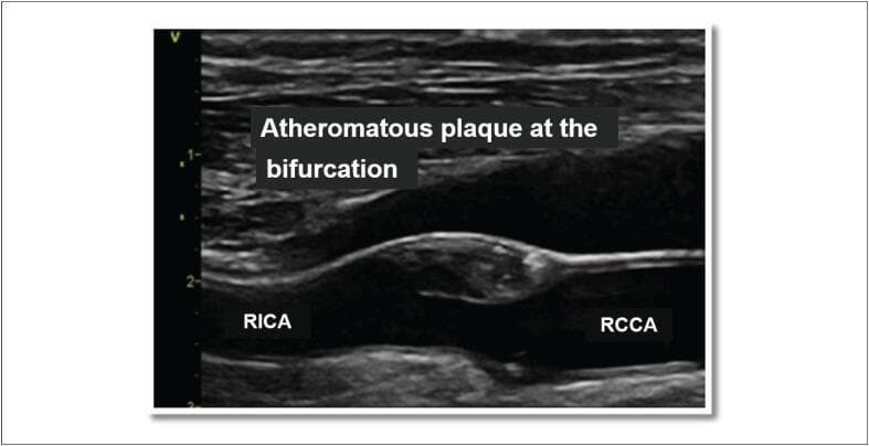 This diagnostic image is a B-mode ultrasound (sonography) of the carotid artery in a longitudinal view. It specifically highlights an atheromatous plaque located at the carotid bifurcation. The image shows the right common carotid artery (RCCA) branching into the right internal carotid artery (RICA). A prominent atherosclerotic plaque is visible as a heterogeneous, predominantly hypoechoic mass protruding from the arterial wall into the vessel lumen, causing significant luminal narrowing (stenosis). The normal arterial walls appear as hyperechoic, smooth linear structures, whereas the plaque exhibits an irregular surface and mixed echogenicity, suggesting a complex composition that may include lipids or necrotic tissue. This finding is clinically significant for evaluating cerebrovascular risk and identifying radiotherapy-induced arterial injuries or chronic atherosclerotic disease. The presence of the lesion at the bifurcation is a hallmark of typical carotid atherosclerosis.