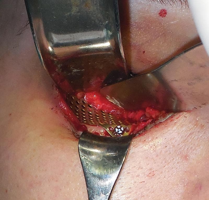 This clinical photograph captures an intraoperative view of an orbital floor reconstruction following a pure blowout fracture. The surgical site is accessed through a transconjunctival approach, with metallic retractors providing exposure of the inferior orbital rim and cavity. Centrally, a titanium mesh implant with a regular perforated grid pattern is visible, precisely contoured to reconstruct the orbital floor boundary. The mesh is rigidly secured to the bone using a micro-screw, visible with a cross-slotted head. The surrounding area shows exposed soft tissue and minor surgical hemorrhage consistent with an active procedure. This image illustrates the surgical management of orbital trauma and the use of internal fixation materials to prevent enophthalmos and muscle entrapment by restoring anatomical volume and structural integrity to the orbit.