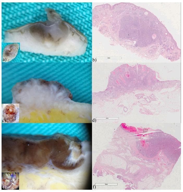 A comparison chart featuring ex vivo dermoscopy (a, c, e) and corresponding histopathology (b, d, f) of common skin malignancies. (a) Vertical ex vivo dermoscopy of an adenoid-cystic basal cell carcinoma (BCC) showing translucent tumor tissue with internal pigmentation invading the dermis. (b) Histology (H&E stain, x15) reveals classic reticulated pseudoglandular basaloid cell clusters and cystic formations. (c) Vertical dermoscopy of invasive squamous cell carcinoma (SCC) illustrating a dense, whitish, elevated mass with irregular borders and epidermal thickening. (d) Histology (H&E, x7) confirms a well-differentiated carcinoma penetrating the reticular dermis with disordered cellular architecture. (e) Vertical dermoscopy of superficial spreading melanoma (Breslow 6mm) depicting a linear, deeply pigmented, asymmetric brown-to-black mass extending into the hypodermis. (f) Histology (H&E, x7) shows asymmetric atypical melanocyte proliferation, ulceration, and focal vascular invasion. This panel demonstrates the correlation between vertical dermoscopic findingsβsuch as tumor color, depth, and invasivenessβand gold-standard histopathological diagnosis in dermatopathology.