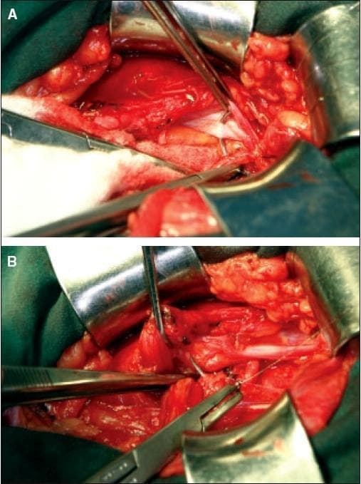 Clinical intraoperative photographs depicting the first layer of posterior wall reconstruction during an inguinal hernia repair. Panel A shows the initiation of the repair near the pubic tubercle, where the lateral flap of the transversalis fascia is being sutured to the lateral edge of the rectus sheath. A needle holder and surgical clamps are visible, demonstrating the technique of reaching underneath the superior-medial flap to anchor the tissues. Panel B illustrates the progression of the reconstruction toward the lateral aspect, redefining the internal inguinal ring. The image demonstrates the integration of the superior stump of the divided lateral cremasteric muscle flap into the suture line. This maneuver is used to buttress the medial edge of the new internal ring, with the suture eventually including a full-thickness bite of the internal oblique muscle and the transversus abdominis aponeurosis. These images highlight the anatomical layers involved in a multi-layered tissue-based hernia repair, specifically focusing on the imbrication of the transversalis fascia and stabilization of the internal ring.
