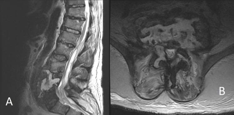 Diagnostic Magnetic Resonance Imaging (MRI) of the lumbar spine featuring T2-weighted sagittal (A) and axial (B) views. The images demonstrate severe pyogenic spondylodiscitis with associated osteomyelitis. In the sagittal view, there is significant osseous destruction of the lower lumbar vertebral bodies (specifically L3-L5), characterized by a near-complete loss of normal vertebral height and the presence of heterogeneous, high T2 signal intensity indicative of marrow edema and necrosis. A large, hyperintense prevertebral and epidural collection is visible, consistent with a complex abscess extending from L1 to L4. The axial view (B) highlights the loss of anatomical integrity of the vertebral body, replaced by ill-defined, fluid-signal intensity regions. There is extensive involvement of the paraspinal soft tissues and distortion of the thecal sac, illustrating advanced vertebral body erosion and the inflammatory spread characteristic of a systemic infection originating from sources such as decubitus ulcers. This clinical image is a primary educational resource for recognizing the radiological hallmarks of spinal infection and destructive spinal pathology.