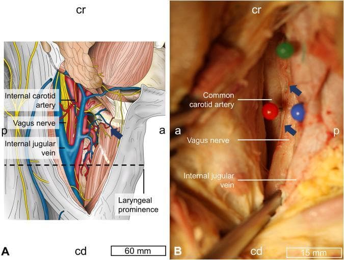 Anatomical and clinical study of the neck topography focusing on the cervical vagus nerve (CVN). Panel A is an anatomical diagram of the carotid triangle region, showing the spatial arrangement of the vagus nerve (yellow), common/internal carotid artery (red), and internal jugular vein (blue) relative to the laryngeal prominence. Orientations are marked as cranial (cr), caudal (cd), anterior (a), and posterior (p). Panel B is a clinical photograph of a cadaveric dissection showing the surgical exposure of the carotid sheath. In this view, the vagus nerve is positioned dorsally (posteriorly) between the common carotid artery (anterior) and the internal jugular vein (ventro-caudal). Blue arrows in panel B highlight the vagal artery—vessels located external to the epineurium of the CVN, a variation observed in nearly 50% of the study population. The content is designed for advanced medical education in surgical anatomy, particularly for procedures such as vagus nerve stimulation (VNS) electrode implantation.