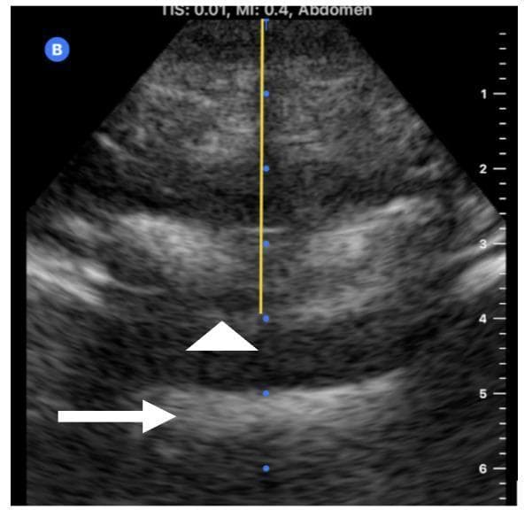 This diagnostic ultrasound image demonstrates spinal anatomy in a transverse view, likely used for neuraxial anesthesia planning or a lumbar puncture. The image features two key anatomical landmarks: the posterior complex (marked by a white arrowhead), which consists of the ligamentum flavum, the epidural space, and the posterior dura mater; and the anterior complex (marked by a white arrow), representing the posterior longitudinal ligament and the vertebral body. The posterior complex appears as a layered, hyperechoic structure superior to the intrathecal space. A vertical yellow caliper line with blue dots extends from the skin surface to the posterior complex, measuring the skin-to-ligamentum flavum distance, which is critical for determining appropriate needle depth. The ultrasound shows typical tissue echogenicity variations, with subcutaneous fat and muscle layers visible superficial to the spinal structures. This visual is an essential educational tool for understanding ultrasound-guided identification of the epidural and subarachnoid spaces.