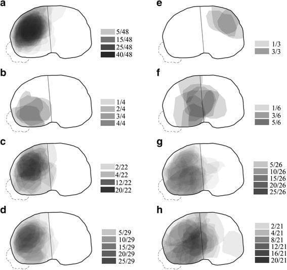 A series of eight grayscale heat maps (labeled a–h) illustrating the frequency and anatomical distribution of articular depression zones in various Schatzker classifications of tibial plateau fractures. The maps utilize a gray-value intensity scale to represent the incidence of depression at specific locations on the tibial plateau surface, with darker shades indicating higher frequency. (a-c) Schatzker type II subtypes: single anterolateral fracture (SALF) shows dense anterolateral depression; single posterolateral fracture (SPLF) shows a localized posterolateral zone; and complex fracture (CF) demonstrates a broad anterolateral distribution extending medially. (d) Schatzker type III shows concentrated lateral depression. (e-f) Schatzker type IV subtypes: single anteromedial fracture (SAMF) and whole medial fracture (WMF) showing varied medial plateau involvement. (g) Schatzker type V shows predominant posterolateral depression. (h) Schatzker type VI displays a central concentration of depression spanning the lateral and medial transition. This diagnostic illustration serves as an orthopedic educational tool for understanding fracture morphology and predicting articular surface damage based on fracture classification.