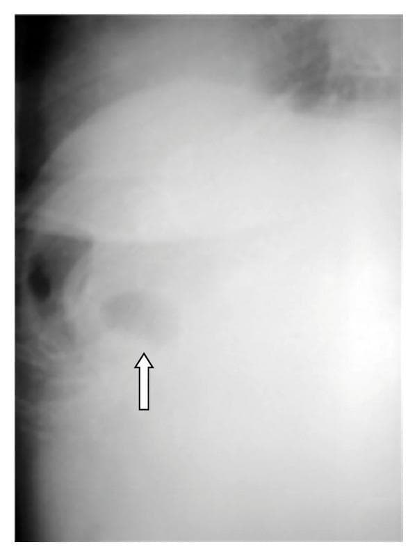 This diagnostic image is a plain abdominal X-ray (radiograph) focusing on the right upper quadrant. The image demonstrates a localized, oval-to-circular radiolucent area (indicated by a white arrow) situated within the anatomical region of the gallbladder. This focal radiolucency is characteristic of pneumobilia or air within the gallbladder (cholecystenteric fistula). The surrounding abdominal area shows general radiopacity, consistent with soft tissue and liver density. The visual finding is a key radiographic sign for diagnosing gallstone ileus, where a cholecystoduodenal fistula has allowed gas from the gastrointestinal tract to enter the biliary system. The primary educational focus is the recognition of abnormal gas patterns (Rigler's triad) in the context of mechanical bowel obstruction caused by a migrated gallstone.