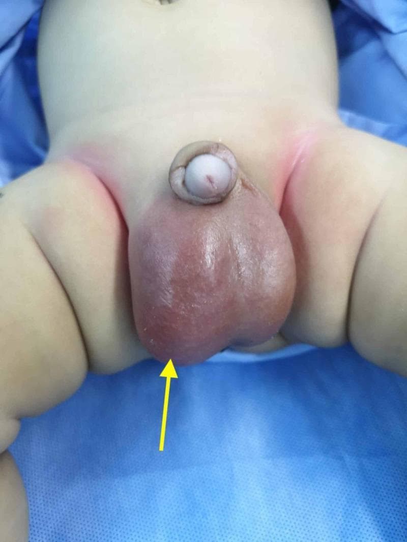 Clinical photograph of a pediatric patient's genital region demonstrating acute scrotal swelling. The image shows a significant, asymmetrical enlargement of the scrotum, predominantly affecting the right hemi-scrotum. The right scrotal sac is distended with a smooth, tense surface and exhibits a marked reddish-purple discoloration (erythema), indicated by a yellow arrow, which is highly suggestive of an underlying inflammatory or infectious process such as an infected hydrocele. The left hemi-scrotum also appears somewhat enlarged, indicating bilateral hydroceles, though it lacks the intense inflammatory color change seen on the right. Mild erythema is also visible in the bilateral inguinal folds. The penis is present and appears structurally normal but is slightly displaced superiorly and laterally by the large scrotal mass. This image serves as a clinical example of the differential diagnosis for an 'acute scrotum' in a pediatric setting, emphasizing the visual signs of secondary infection or inflammation complicating a simple hydrocele.