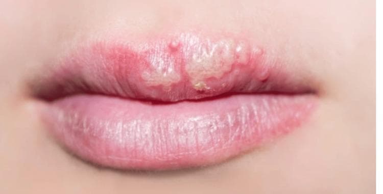 This clinical photograph shows a close-up view of a patient's mouth, specifically focusing on the upper lip. The image demonstrates a cluster of small, translucent to whitish vesicles localized on an erythematous base. These primary skin lesions are characteristic of a herpetic infection. The distribution is clustered and follows the vermillion border of the upper lip, predominantly on the patient's left side. The vesicles appear tense and grouped, causing an irregular disruption of the smooth transition between the lip mucosa and the surrounding cutaneous tissue. There is visible peri-lesional inflammation indicated by localized redness (erythema), while the adjacent skin and the lower lip appear unaffected. This visual is a classic representation of orolabial herpes (Herpes Simplex Virus), often referred to as herpes labialis or cold sores. The clinical significance of this image lies in illustrating the morphology and specific anatomical predilection of HSV-1 manifestations for educational diagnostic purposes in dermatology and primary care.