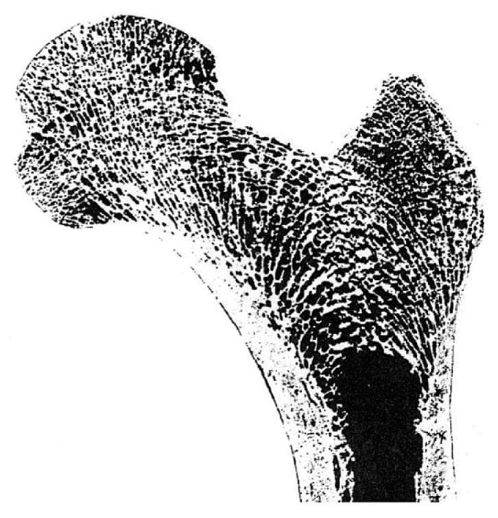 This diagnostic clinical image shows a high-contrast coronal cross-section of the proximal human femur, illustrating the classic anatomical landmarks including the femoral head, neck, greater trochanter, and the superior portion of the femoral shaft. The image highlights the distinctive internal architecture of bone, primarily the cancellous (trabecular) bone and the outer cortical bone layer. The trabecular network is highly organized, demonstrating clear orientations that correlate with Wolff’s Law, where bone grows in response to the loads placed upon it. Specifically, the primary compressive trabeculae are seen radiating from the superior aspect of the femoral head down through the neck, while tensile trabeculae arc across from the lateral cortex through the neck toward the head. The greater trochanter shows a less organized but distinct spongy structure. The dense cortical bone is visible as a thick perimeter, particularly along the medial and lateral aspects of the femoral shaft. A dark, solid region at the center of the shaft represents the medullary cavity. This image serves as a fundamental educational tool for orthopedic biomechanics, anatomy, and the study of bone density and stress distribution.