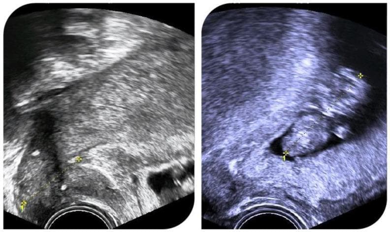 Diagnostic Image: Two side-by-side transvaginal ultrasound frames illustrating a successful intrauterine pregnancy in a patient following radical abdominal trachelectomy. The images demonstrate the pelvic anatomy with a focus on the cervix and lower uterine segment. Key visible features include a hyperechoic (bright) band representing a cerclage suture, positioned at the base of the uterus to provide structural support for the shortened cervix. The left frame shows a measurement of the cervical length (indicated by calipers and a dotted line). The right frame shows a gestational sac containing an embryo/fetus, visualized as a hypoechoic (dark) fluid-filled structure against the heterogeneous echotexture of the uterine myometrium. The educational focus is on the monitoring of cervical competence and the integrity of a prophylactic cerclage in a post-trachelectomy obstetric patient. Medical specialty: Obstetrics and Gynecology, Gynecologic Oncology. Clinical significance: Demonstrates the feasibility of pregnancy and the role of cerclage after radical fertility-sparing surgery for cervical cancer.