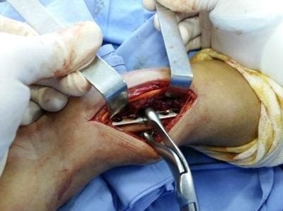 This clinical photograph captures an intraoperative view of an orthopedic surgical procedure on the forearm, specifically demonstrating the Henry anterior approach. The surgical field shows an open longitudinal incision with skin and subcutaneous tissues held back by two metal retractors (Farabeuf type), exposing the deep muscle layers and the underlying radius. Within the incision, a metallic internal fixation plate with multiple screw holes is positioned over the bone to treat a Galeazzi fracture-dislocation. A pair of surgical forceps (plate holders) is visible, stabilizing the hardware against the bone surface. The surrounding area is draped with blue sterile surgical cloths, and the operating surgeon's hands are visible in white sterile gloves. The image illustrates the principles of open reduction and internal fixation (ORIF), highlighting anatomical exposure and the use of orthopedic instrumentation for fracture stabilization.