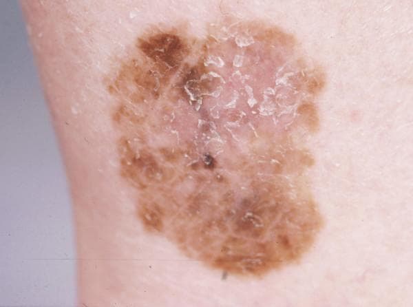 This clinical photograph shows a pigmented skin lesion on the ankle, characteristic of a superficial spreading melanoma. The lesion demonstrates the classic 'ABCDE' criteria: it is asymmetric in shape and shows significant border irregularity with poorly defined, notched margins. There is marked color variegation, with a primary palette of light to dark brown and focal areas of darker black-brown pigmentation. A central area of relative hypopigmentation suggests possible regression. The surface texture is uneven, with visible fine scaling and focal hyperkeratosis in the central portion. The lesion is relatively flat, consistent with the radial growth phase of superficial spreading melanoma. This image serves as a teaching example for dermatologic assessment of suspicious melanocytic lesions in a lower extremity location, highlighting the importance of recognizing irregular pigment distribution and evolving surface features in clinical oncology and dermatology.
