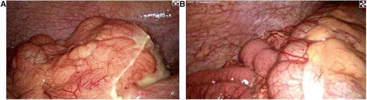 Two-panel laparoscopic images showing an intraoperative exploration for acute abdominal pain. Panel A demonstrates a localized inflammatory mass in the left iliac fossa. The mass is enclosed by the greater omentum and exhibits significant purulent exudate (pus moss) on its surface, indicating a suppurative process. Panel B illustrates the underlying congenital anatomical variation: intestinal malrotation. The ileum is located in the right iliac fossa, displacing the cecum and ascending colon toward the left side of the abdomen. The bowel surfaces appear hyperemic with visible vascularity, consistent with peritonitis. Collectively, these images document a rare clinical presentation of left-sided appendicitis occurring in the context of intestinal malrotation. The visuals focus on the surgical findings of aberrant intestinal positioning and the localized infectious mass causing left-sided symptoms.