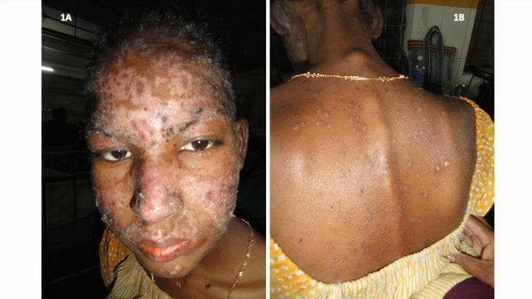 Two-panel clinical photograph (1A and 1B) illustrating cutaneous manifestations of Systemic Lupus Erythematosus (SLE). Image 1A shows a frontal view of a patient's face with a prominent erythematous malar rash extending across the bridge of the nose and cheeks. The rash demonstrates noticeable surface scaling and a characteristic sparing of the nasolabial folds, which is a classic diagnostic feature of the 'butterfly rash' in SLE. Image 1B displays the patient's posterior trunk (back), showing multiple scattered discoid-shaped lesions. These cutaneous lesions are erythematous with varying degrees of heaped-up, adherent scales on their surfaces, consistent with discoid lupus erythematosus (DLE) features. The visual presentation highlights key dermatologic findings used in the diagnosis and classification of autoimmune connective tissue diseases, focusing on morphology, scaling, and anatomical distribution.