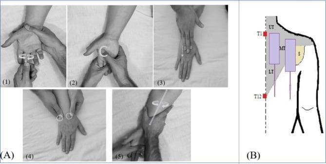 This composite educational graphic illustrates two clinical interventions for post-laparoscopic shoulder pain (PLSP). Panel A contains five clinical photographs demonstrating a hand and forearm massage protocol: (1) finger massage with direct pressure, (2) palm kneading using C-shaped movements, (3) dorsal hand stretching, (4) circular thumb friction around the wrist carpals, and (5) longitudinal forearm effleurage with gentle twisting. Panel B is an anatomical diagram of the upper back and shoulder region, highlighting the trapezius muscle (shaded gray) and scapula (labeled S, shaded yellow). The diagram identifies the anatomical subdivisions of the trapezius: Upper (UT), Middle (MT), and Lower (LT). It specifically marks electrode placement for Transcutaneous Electrical Nerve Stimulation (TENS) therapy, with vertical purple boxes representing the active areas between vertebral landmarks T1 and T12. This figure demonstrates non-pharmacological pain management techniques relevant to physical therapy and postoperative nursing care.